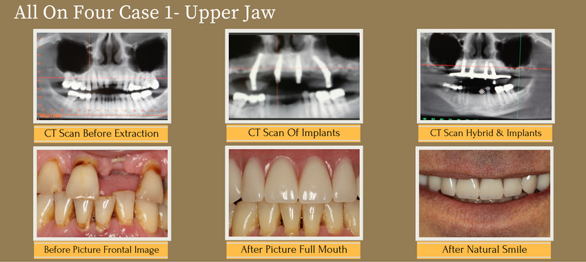 all-on-four-upper-jaw
