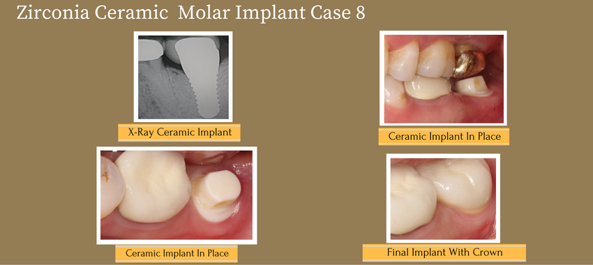 ceramicimplantcase8