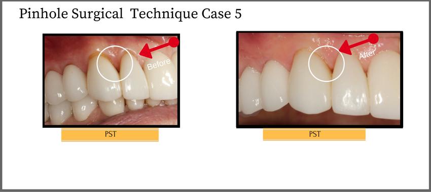pstcase5