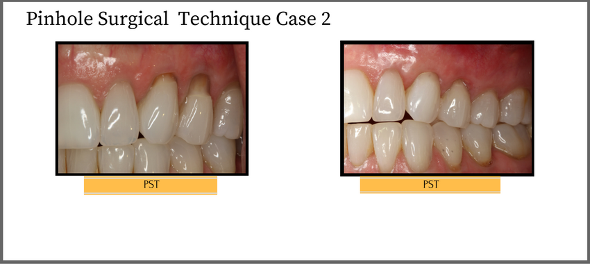 pinholesurgicaltechniquecase2