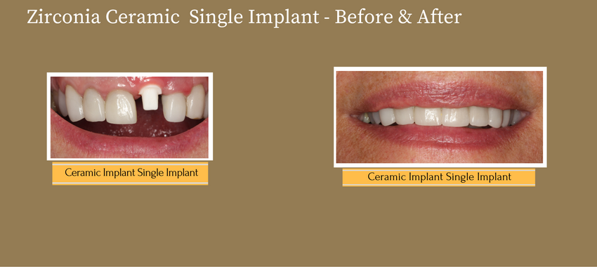 singleimplant1