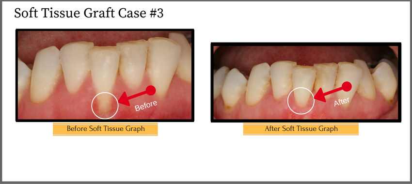 softtissuegraftcase3