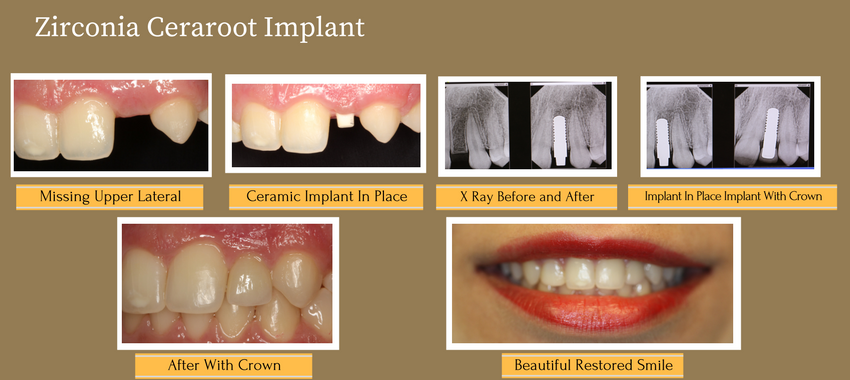 Zirconia Ceraroot Imlant Sahar