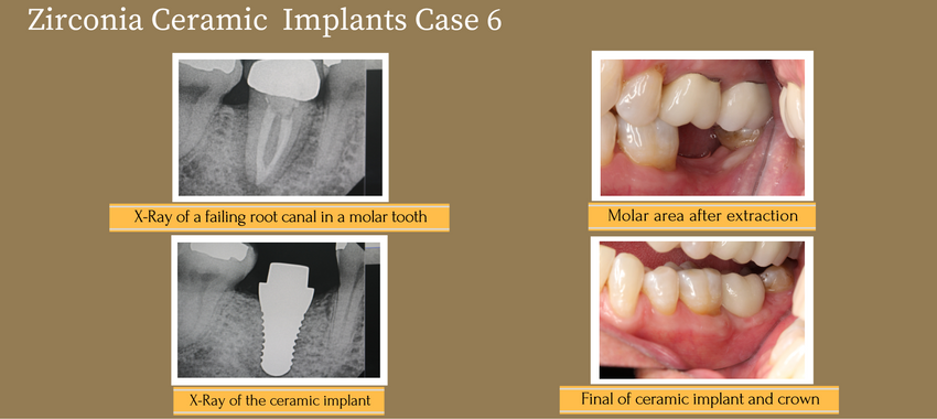 zirconiaceramicimpantcase7