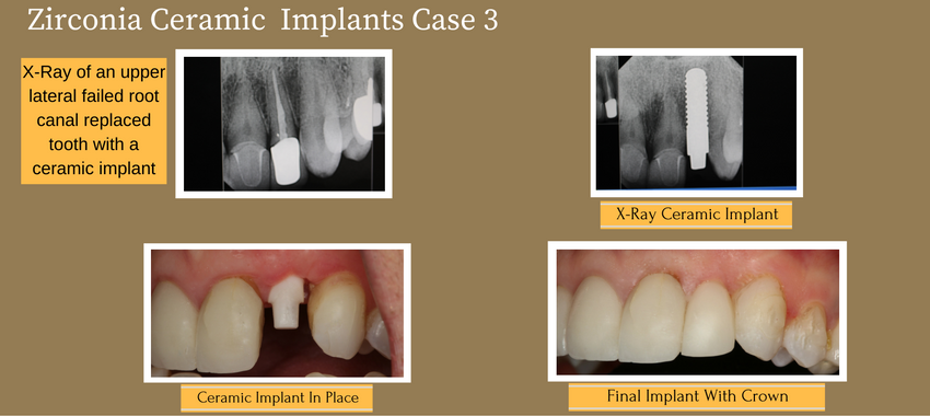 zirconiaceramicimplantcase3