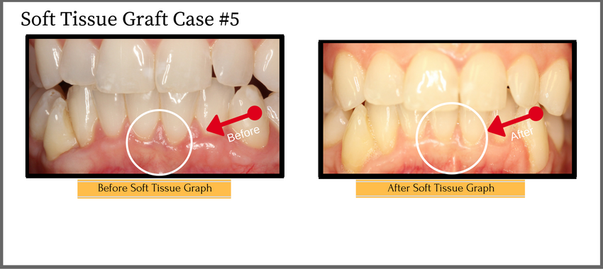 softtissuegraft5a