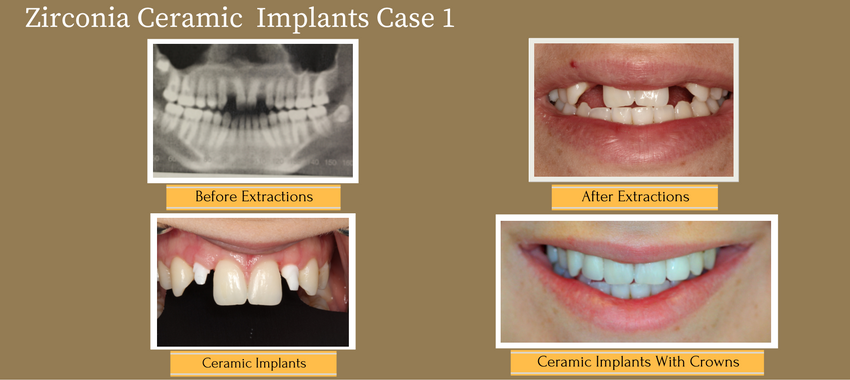 zirconia-ceramic-implants-case-1