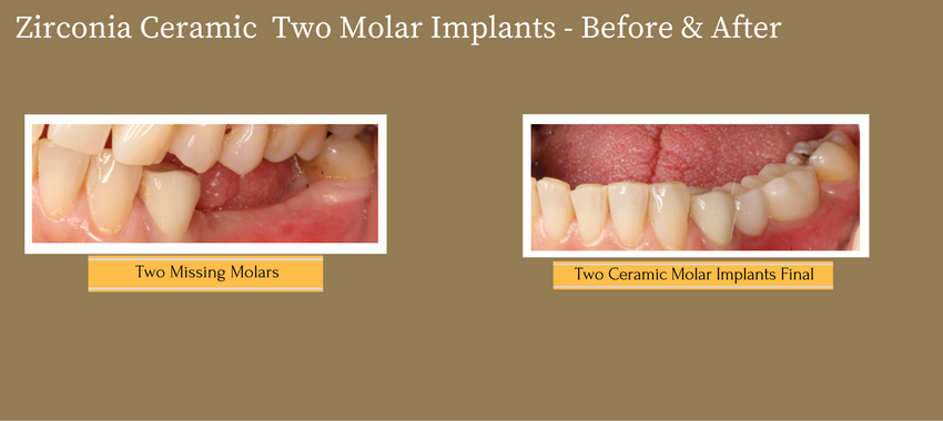 2molarimplants