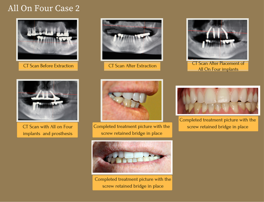 all-on-four-case-2