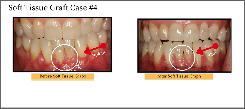softtissuegraftcase4