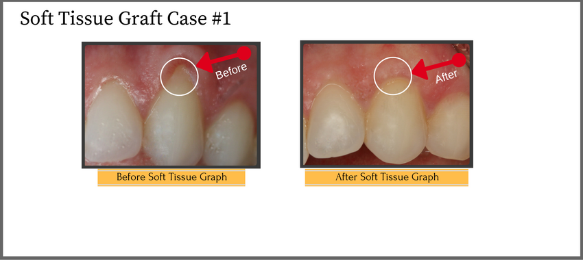 softtissuegraphcase1