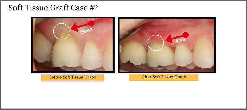 softtissuegraphcase2