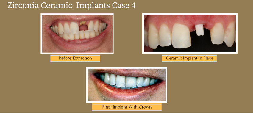 zirconiaceramicimplantcase4