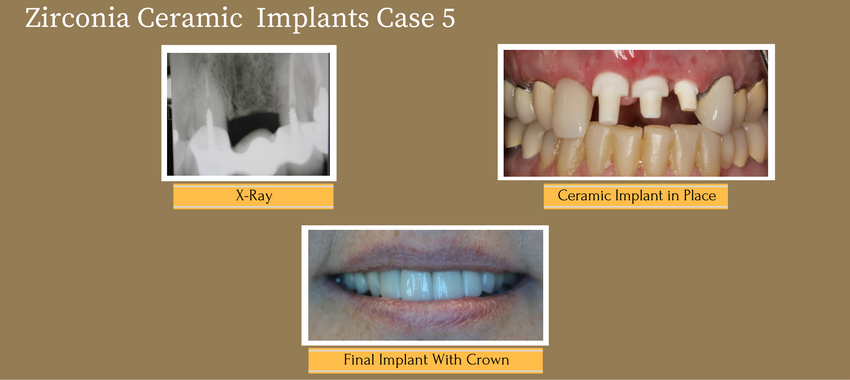 zirconiaceramicimplantcase5