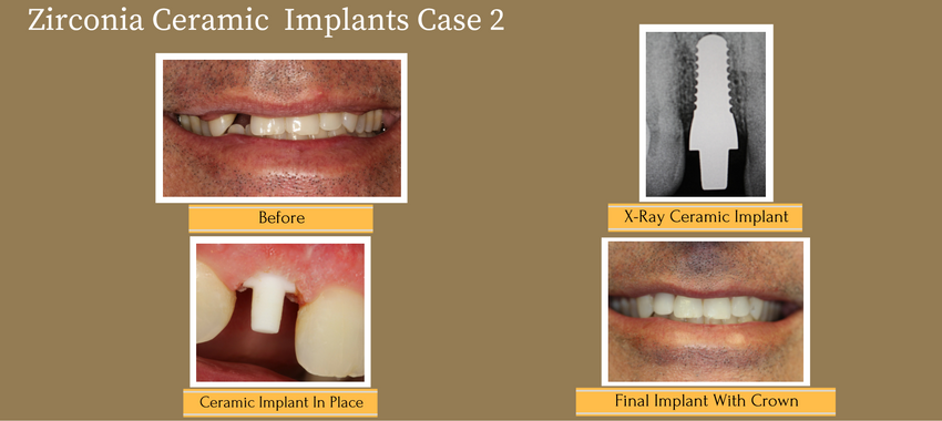 zirconiaceramicimplantcase2