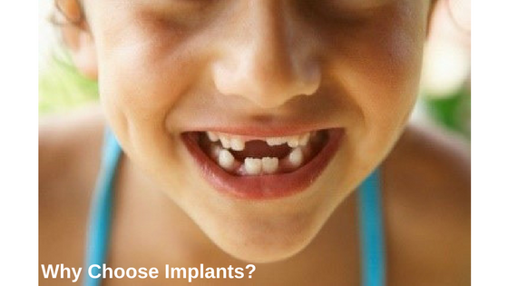 Why Choose Implants?
