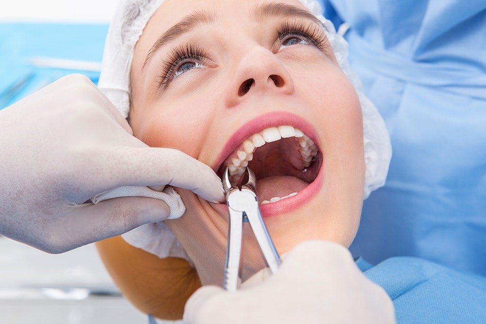 Tooth Extraction; Reasons, Procedure, Before and After -  missionimplantcenter