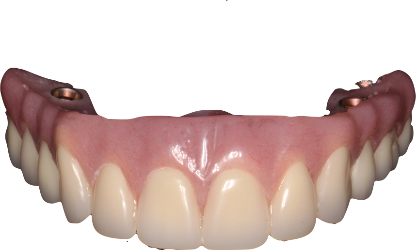 WHAT ARE THE BENEFITS OF DENTURES SUPPORTED BY IMPLANTS?
