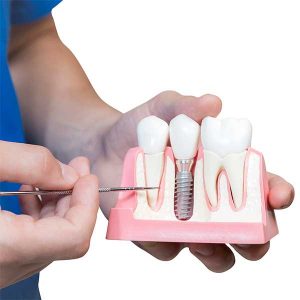 dental-implant-method-300x300