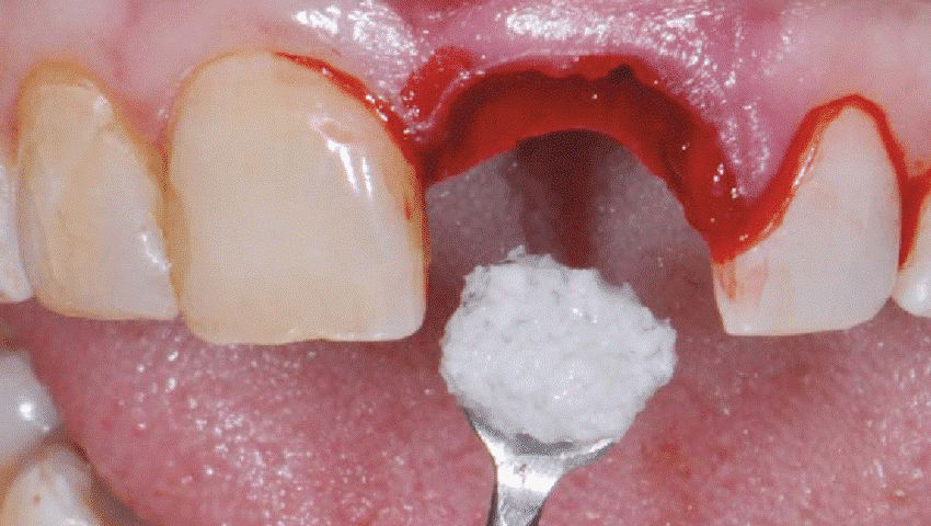Ridge Augmentation The Procedure And Benefits Ridge Augmentation The Procedure And Benefits