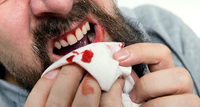 Bleeding gums(How to prevent and stop gums from bleeding)
