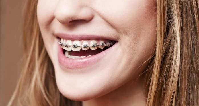 Different types of dental braces for children and adults