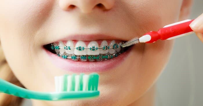 How to Take Care of Braces on teeth diet, brushing and flossing