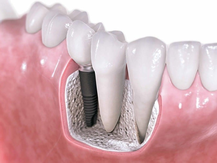 dental Implant procedure steps to have a beautiful smile