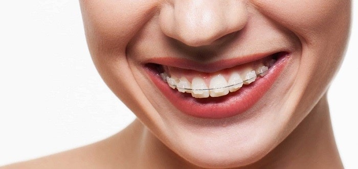 ceramic braces to treat malocclusions and bad bites