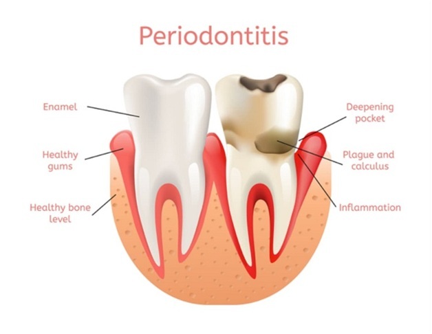 how much does it cost to treat periodontal disease in dogs