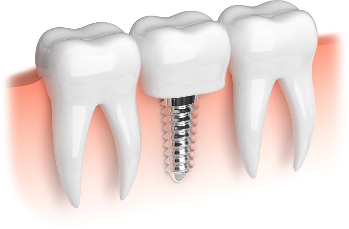 Adjacent teeth are not compromised to replace missing teeth