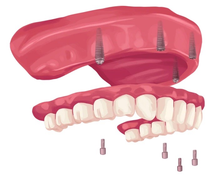 All on four dental implant procedure benefits and recovery
