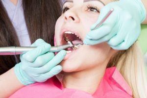Dental Tartar Cleaning Application