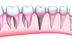 Dental implant benefits replace missing teeth by implants