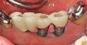 Dental implant infection how to treat infected implant