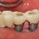 Dental implant infection how to treat infected implant