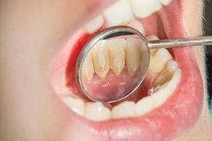 How to prevent and remove tartar(calculus, plaque) from teeth