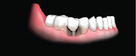 Causes of Dental Implant Infection (Peri-implantitis)