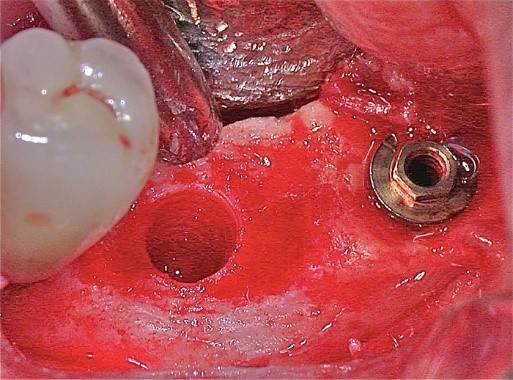 Common implant removal methods – techniques