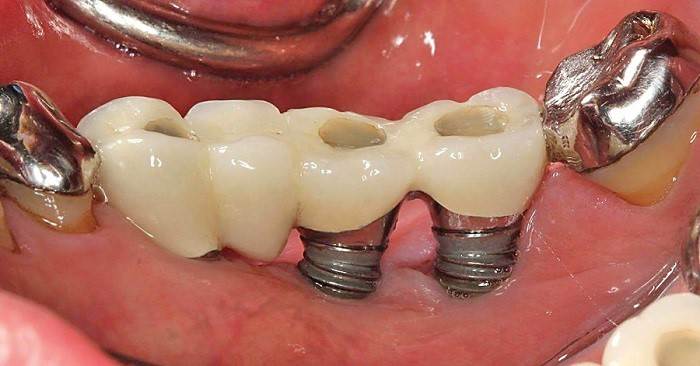 Diagnosing an Infected Dental Implant