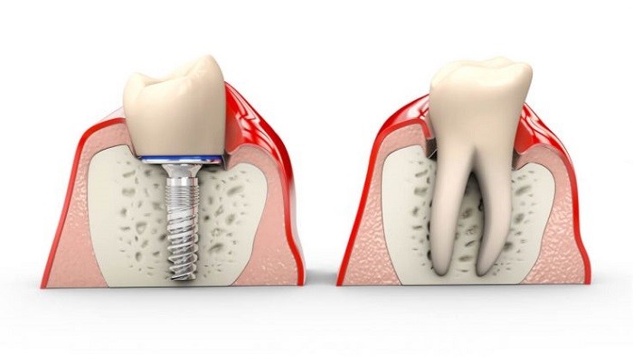 Gum Disease and Bone Loss