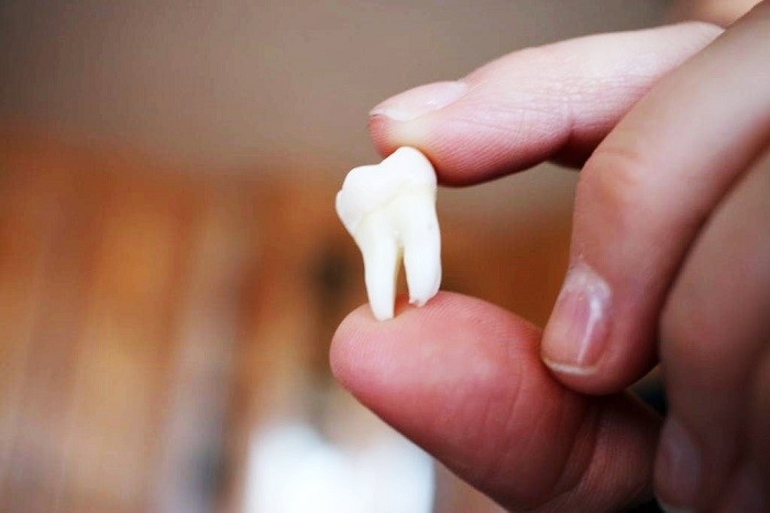 How-Wisdom-Tooth-Removal-Proceeds