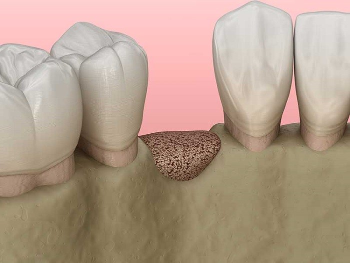 Jawbone regeneration to have a better dental implant