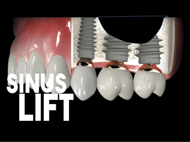 Sinus Lift