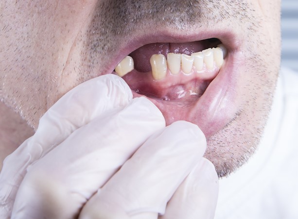TOOTH EXTRACTIONS