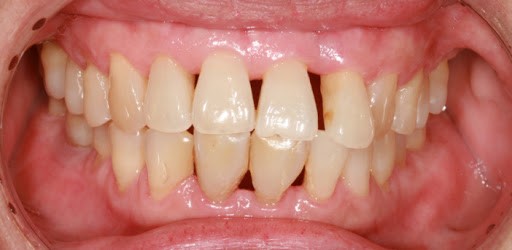 What Is Periodontal Disease