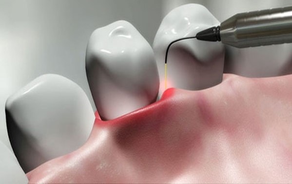 Advantages of Laser Dental Implant Procedure