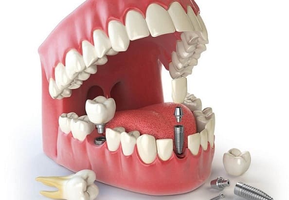 Ailing and failing dental implants