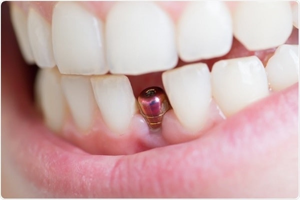 Ailing and failing implant causes