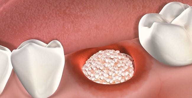 Bone Graft Procedure